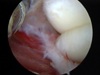 Picture2 Arthroscopic Elbow Arthrofibrosis Release