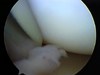 Picture4 Arthroscopic Elbow Arthrofibrosis Release