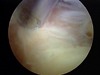 Picture5 Arthroscopic Elbow Arthrofibrosis Release