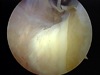 Picture6 Arthroscopic Elbow Arthrofibrosis Release