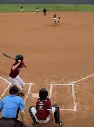 Elbow Arthroscopy in a 12 yo pitcher