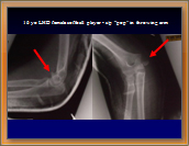 Figure1 Medial Epicondyle Avulsion Fracture