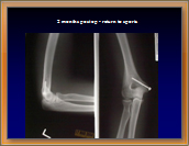 Figure5 Medial Epicondyle Avulsion Fracture