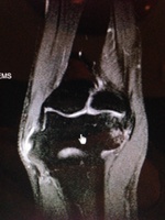 Figure1 Ulnar Nerve Transposition